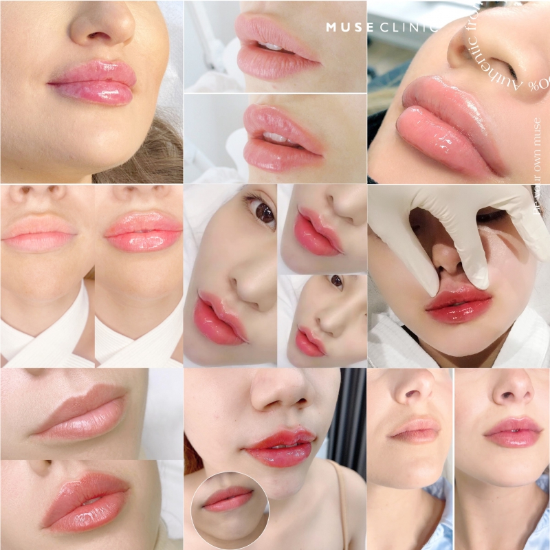 Cân chỉnh khuôn mặt toàn diện với phương pháp tiêm Filler